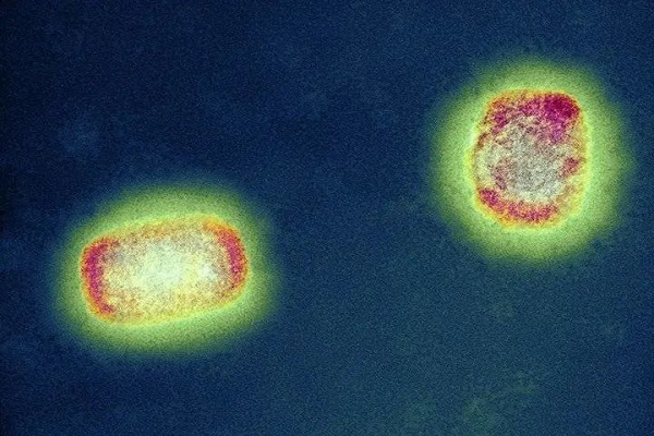 Kháng nguyên Thử nghiệm nhanh: Monkeypox, bị thế giới bỏ bê, sẽ trở thành căn bệnh siêu truyền nhiễm tiếp theo?